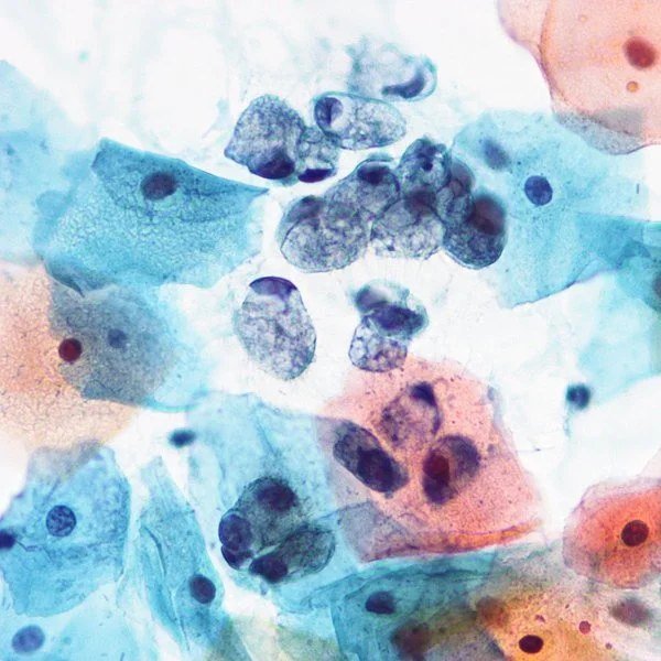 c9eac8ede066b24bbeb83590e5367b79.jpg HMB-45 MARCADOR DE INMUNOHISTOQUÍMICA - Imagen 1